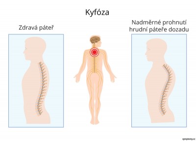 kulata-zada-kyfoza.jpg